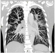 肺野腫瘍（MIP）